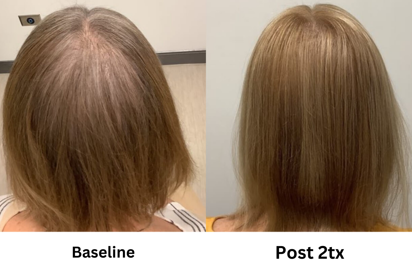 AlmaTED Treatment- Hair Loss Prevention